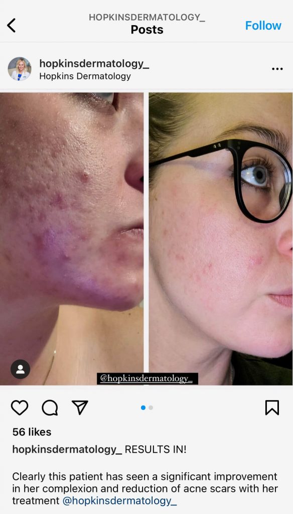 Hopkins Dermatology before-and-after photos; social media content ideas for doctors